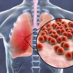Что такое атипичная пневмония?